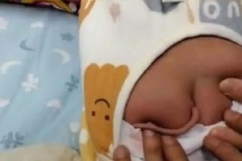 Bebê recém-nascido nasce com cauda de 10 cm na China